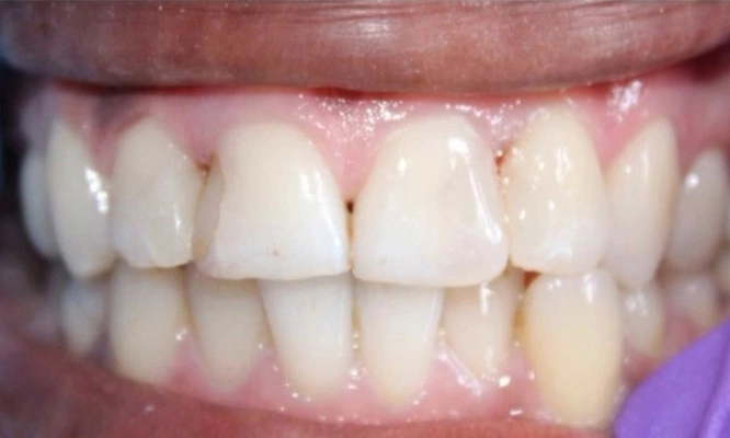 decayed teeth after