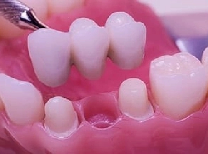 fixed partial dentures