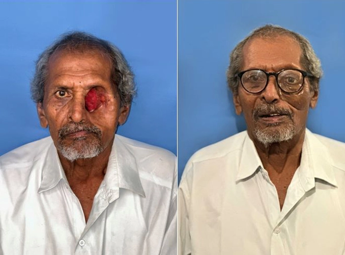 complete dentures