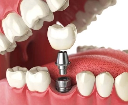 complete dentures