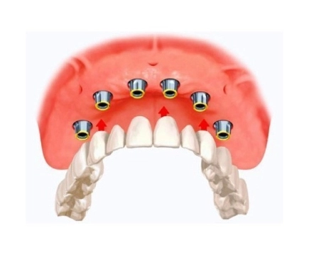 fixed partial dentures