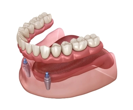 complete dentures