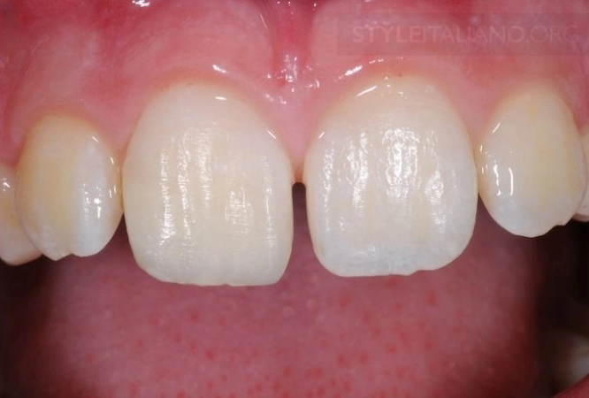 Restoration of Broken and Decayed Teeth