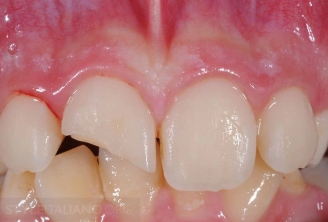 Restoration of Broken and Decayed Teeth