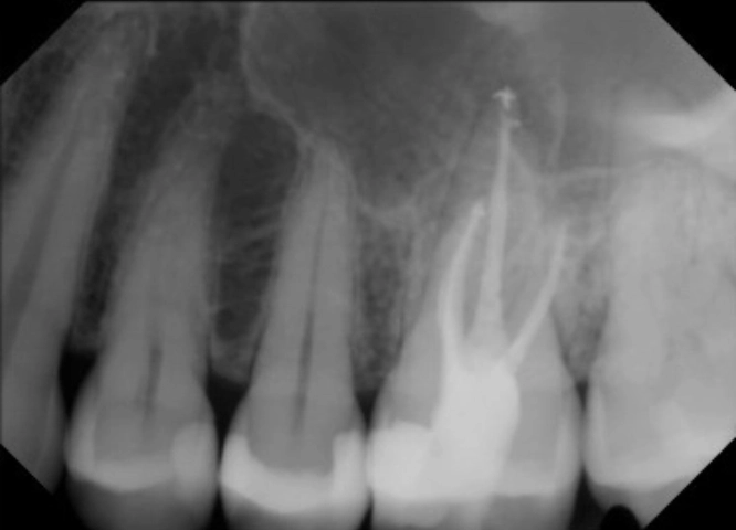 root_canal_reatment2_after