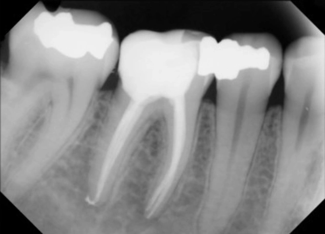 root_canal_treatment1_after