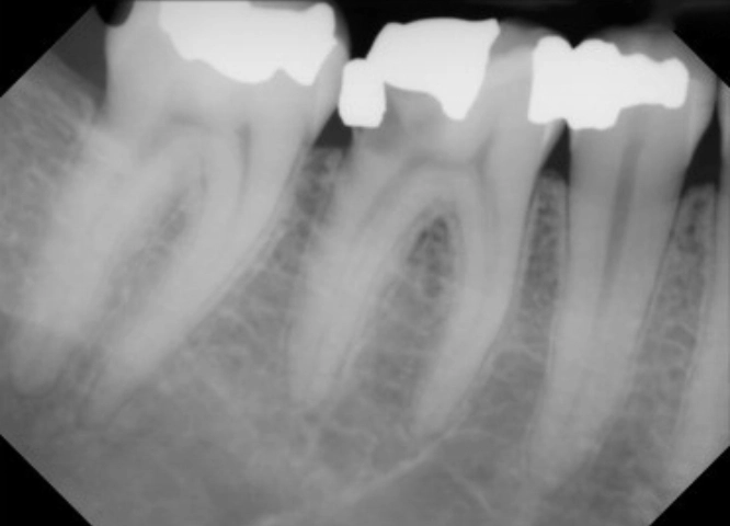 root_canal_treatment1_before