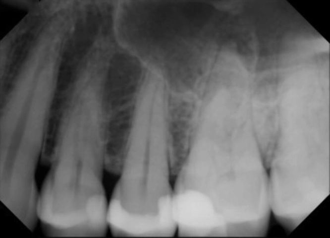 root_canal_reatment2_before