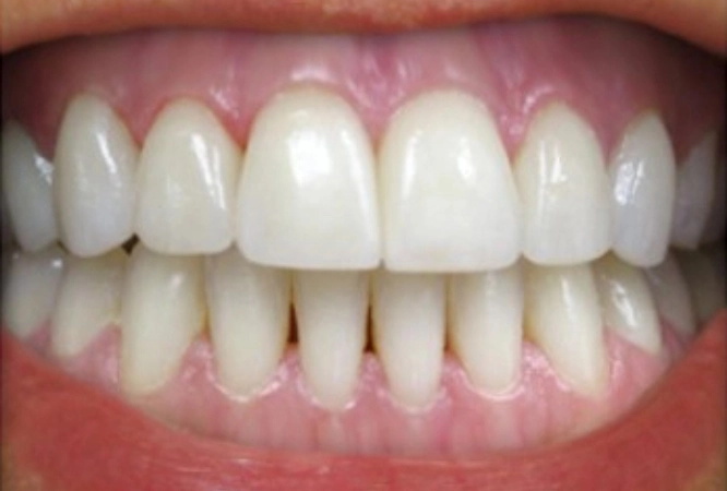 teeth whitening