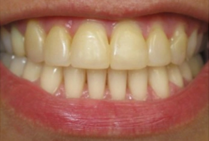 teeth whitening