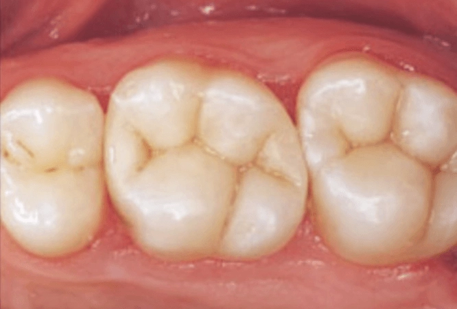 tooth coloured restorations after