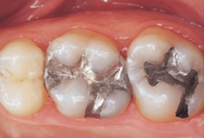 tooth coloured restorations before