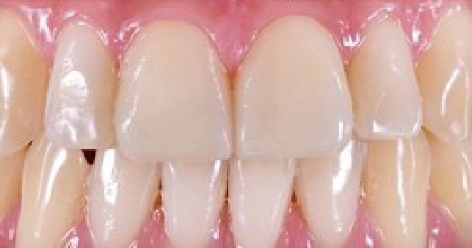 veneers after