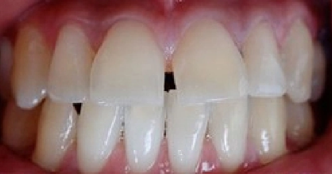 veneers before